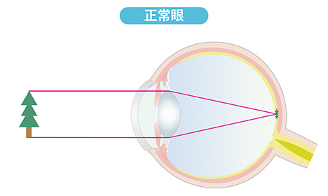 正常眼