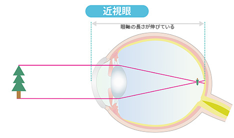 近視眼