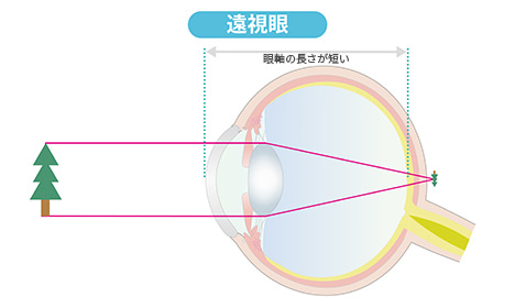 遠視眼