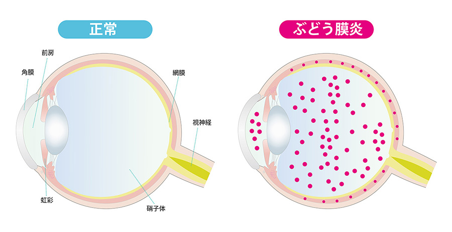 虹彩炎