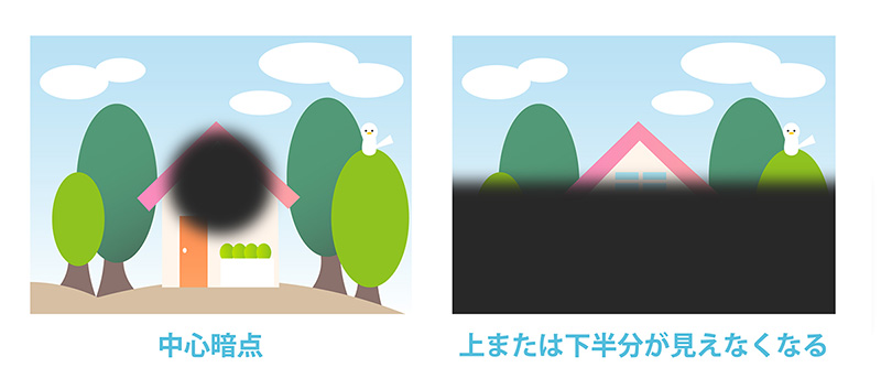 視神経症(視神経炎)|日本眼科学会による病気の解説
