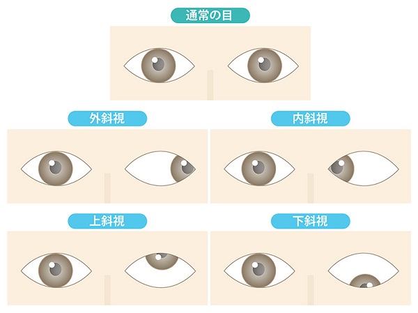 左右 の 目 の 焦点 が 合わ ない