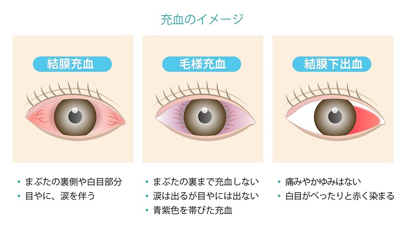 の 出血 原因 白目 結膜下出血（よくある目の病気 39)